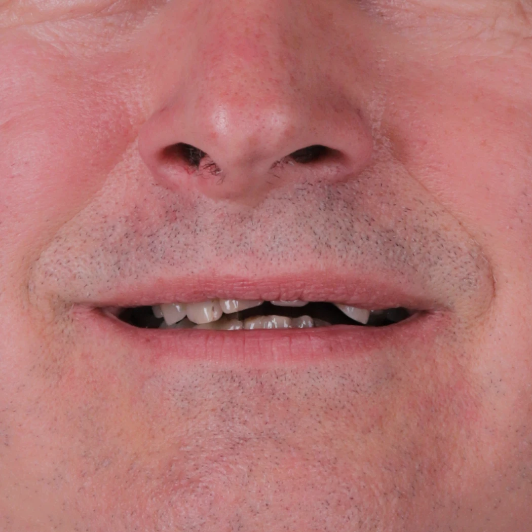 Metamorfoza Smile Today Concept - przed